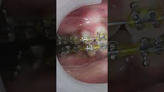 Results of class 2 elastics in 2 months orthodontist braces treatmentdentist real dentistry [upl. by Analli]