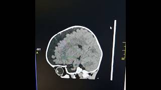 Agenesis of corpus callosum  External hydrocephalus [upl. by Weld383]