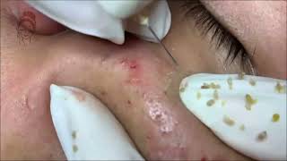 Relax Every Day acne pimplepopping blackheads [upl. by Cinimod13]