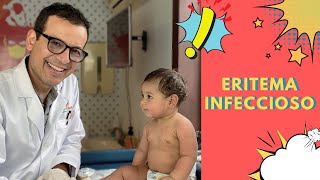 Eritema infeccioso que es y como se diagnostica [upl. by Kunin932]