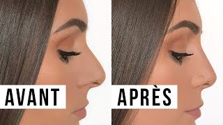 MA RHINOPLASTIE  AVANTAPRÈS PRIX EXPÉRIENCE etc│PerfectHonesty [upl. by Enrobso352]