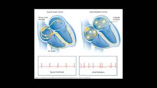 Atrial Arrhythmia Disease healthcare health disorder [upl. by Kassaraba]