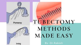 Tubectomy methods [upl. by Gobert]