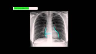 Chest XRay Reading Method  ABCDE UndergroundMed [upl. by Ettigdirb]