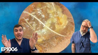 This Earwax Removal Is Unbelievable  EP1006 [upl. by Knobloch]