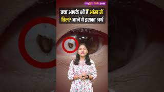 Mole On Eyes जानें आंख के अंदर तिल होना किस बात की ओर करता है इशारा। mole on inside eyes। [upl. by Isidro]