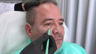 Acido Hialuronico Facial Region Periorbitaria Malar y Tercio Medio por Dr Martin Gaston Alvarez [upl. by Rekab]