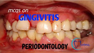 MCQs on Gingivitis  Periodontology  Dentophile [upl. by Etnoj]