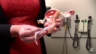 Mayo Clinic Minute Tampon test for endometrial cancer [upl. by Aehsila]