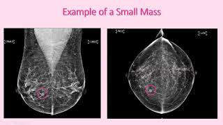 Screening Test Mammography for Breast Cancer [upl. by Corabelle706]