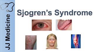 Sjogren’s Syndrome quotDry Eye Syndromequot  Primary vs Secondary Symptoms Diagnosis and Treatment [upl. by Ynattir301]