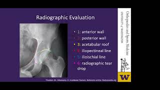 Posterior Wall Acetabular Fracture Management and Outcomes [upl. by Assirat]