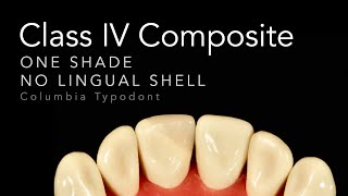 Class IV Composite Restoration  Step by Step One Shade Class IV Restorations [upl. by Dnaletak]