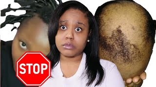 🚨Braids Cause Hair Loss BRAIDS amp BALDING‼️What Every BW Should Know‼️ IamCynDoll [upl. by Vickey]