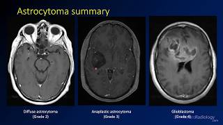 Imaging brain tumors  2  Astrocytomas [upl. by Vala]