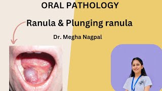 Ranula  Oral Pathology  Understand in 5 Mins [upl. by Aicetal]