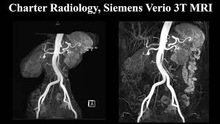 Renal MRA [upl. by Fowler]