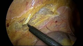 laparoscopic left hemicolectomy for carcinoma descending colon by Dr Rashesh Solanki [upl. by Han724]