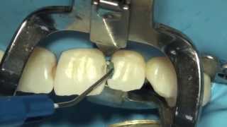 Tokuyama Dental Estelite Sigma Quick ile Restorasyon [upl. by Ahsiadal]