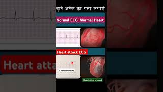 इस तरह होती है हार्ट अटैक की दस्तक Normal ECG vs Heart Attack ECG Whats the differenceshorts [upl. by Yehudit]