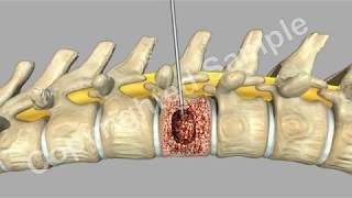 Back Surgery Kyphoplasty [upl. by Lodnar]