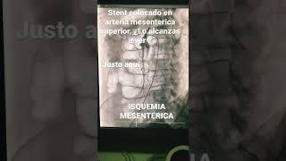 Isquemia mesentérica crónica resuelta por un Stent [upl. by Amor]