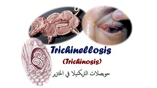 Lecture 47 Trichinellosis Trichinosis حويصلات التريكنيلا في الخنزير [upl. by Akehsal]