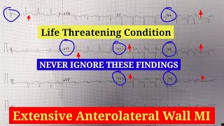 Extensive Anterior Wall Myocardial Infarction ECG interpretation  Anterolateral Wall MI ECG [upl. by Aztilay565]