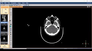 DICOM viewer software the easiest way to review CTs and MRIs on your PC [upl. by Anel]