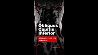 Obliquus Capitis Inferior Muscles and Stomach Sleepers Headache [upl. by Jae524]