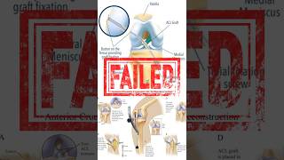 ARTHROSCOPIC ACL REVISION SURGERY [upl. by Eisen]