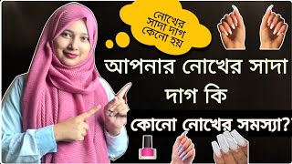 আপনার নোখের সাদা দাগ কি কোনো নোখের সমস্যা নোখের সাদা দাগ কেনো হয়HealthRoof banglahealthtips [upl. by Kalinda399]