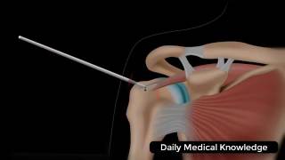 Arthroscopic Rotator Cuff Repair Surgery Animation [upl. by Eciryt]