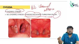 Choanal Atresia  By Dr Shubham Mittal  ENT [upl. by Akeyla32]