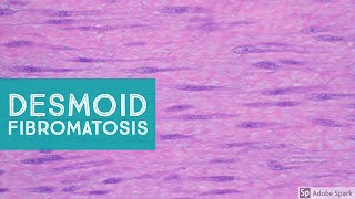 Desmoid Fibromatosis Desmoid Tumor  Explained by a Soft Tissue Pathologist [upl. by Tekcirk]