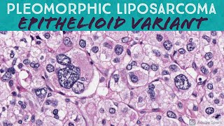 Pleomorphic Liposarcoma Epithelioid Variant [upl. by Trotta343]