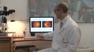 Epiretinale Membran  Macular Pucker Prof Findl Wien [upl. by Worlock17]