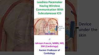 Leadless pacemaker having wireless communication with subcutaneous ICD [upl. by Assiruam415]