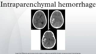 Intraparenchymal hemorrhage [upl. by Hardwick58]