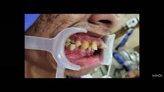 treatment of anteriorly proclined teeth [upl. by Nedla745]