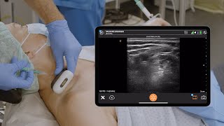 Preop POCUS of the Diaphragm Lung and Brachial Plexus [upl. by Ttayw]