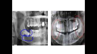 Dentigerous cyst [upl. by Mychal]