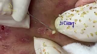 Loan Nguyen Acne Treatment 16388 [upl. by Angelle361]