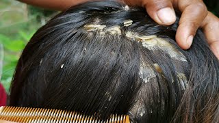 Itchy Dry Scalp and Scratching Treatment  Psoriasis  Dandruff Removal  Huge Flakes Part 215 [upl. by Kavita975]