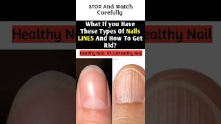 Do You Have Vertical or horizontal lines or Ridges On Your Nails Cause shorts nails ridges [upl. by Anselme]