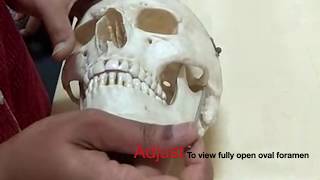 Gasserian ganglion Trigeminal block  made simplified by demo on the skull [upl. by Julianna794]