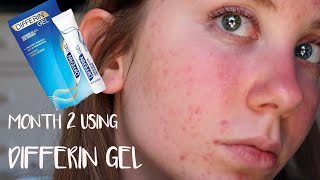 MONTH 2 USING DIFFERIN GEL  Skin Update [upl. by Kushner]