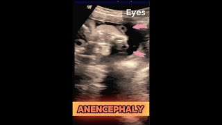 ANENCEPHALY  25wks Pregnancy  Baby without Head ultrasound pregnancy congenital baby [upl. by Aikenat]