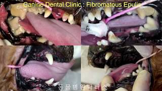 FIBROMATOUS EPULIS 치은종 [upl. by Lanaj]