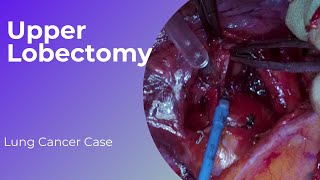 Right Upper Lobectomy 22 [upl. by Brenan]